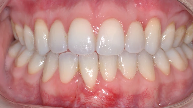 Depois - Retrações